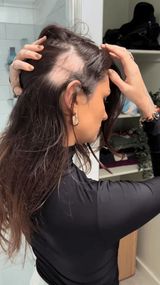 Hair Patches at MiST